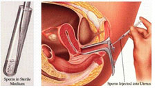 IUI performed by Dr. Anita Singh at Lifestart Fertility Center, Los Angeles