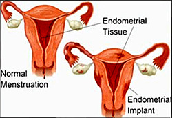 Los Angeles Endometriosis Doctor - Dr. Anita Singh