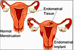 endometriosis.jpg - 24.75 kB